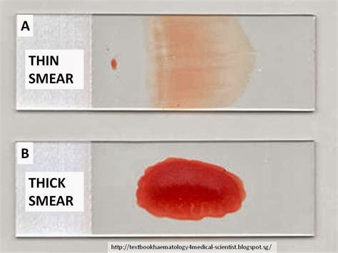 thick and thin smear test|thick vs thin smear malaria.